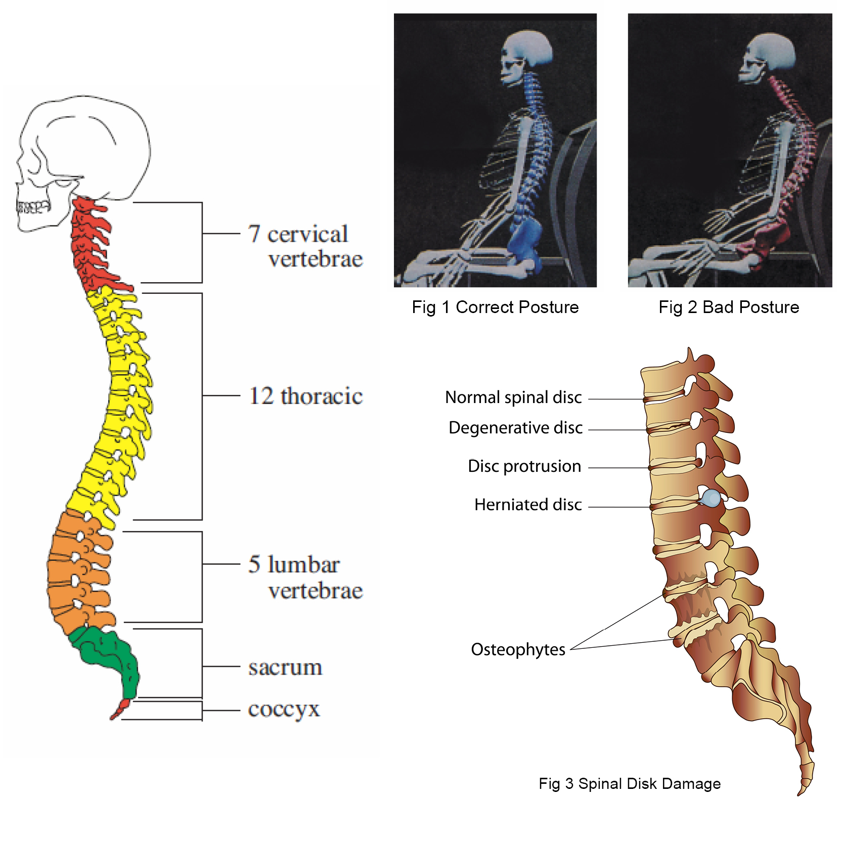 Ergonomic Back Care Spine Damage